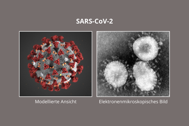 SARS-CoV-2, das neuartige Coronavirus in der modellierten Ansicht und im elektronenmikroskopischen Bild